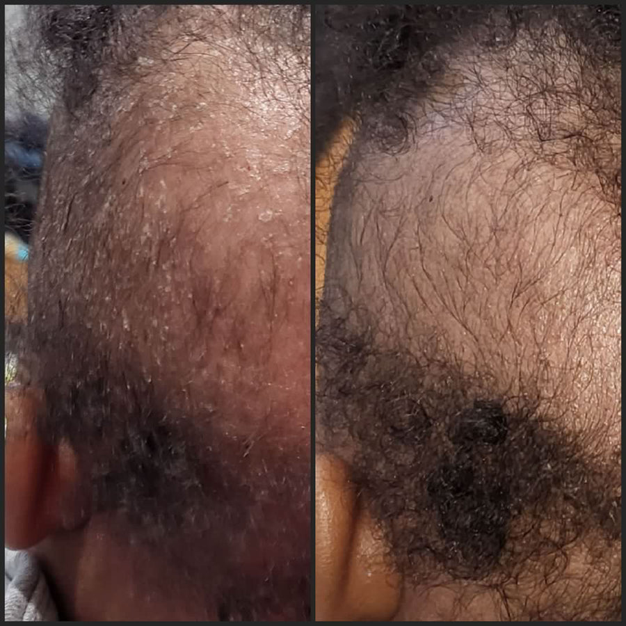 Loosen flakes, soothe the scalp