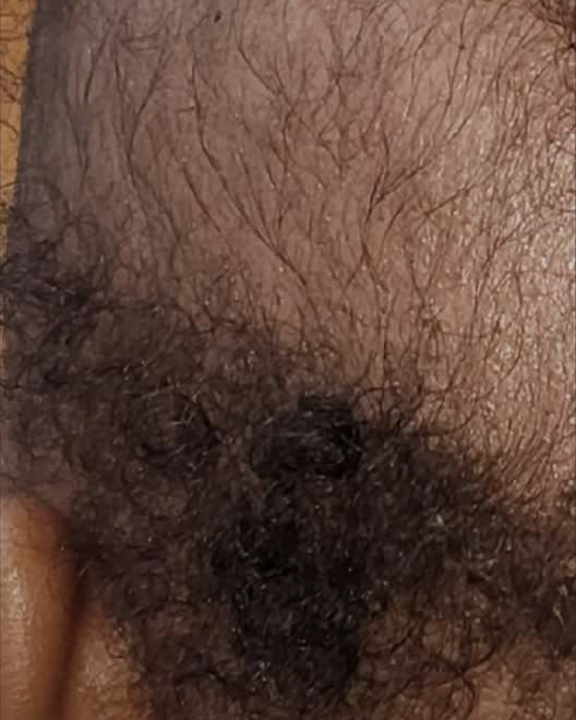 The same baby's scalp at the same angle, near the hairline and ear, photographed later