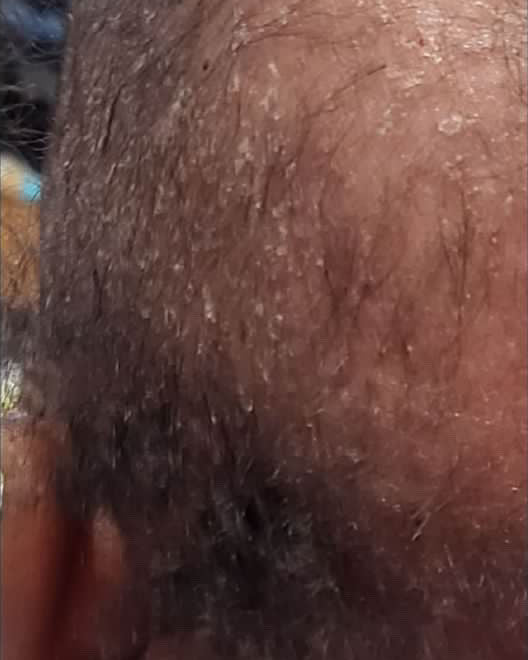 A baby's scalp near the hairline and ear with visible dry flaking