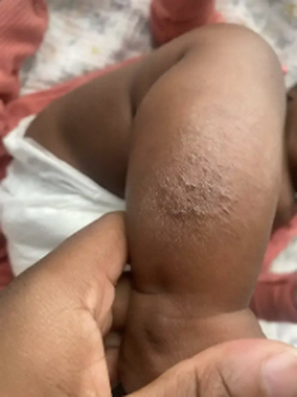 A baby's thigh with a patch of dry, raised, eczema-prone skin